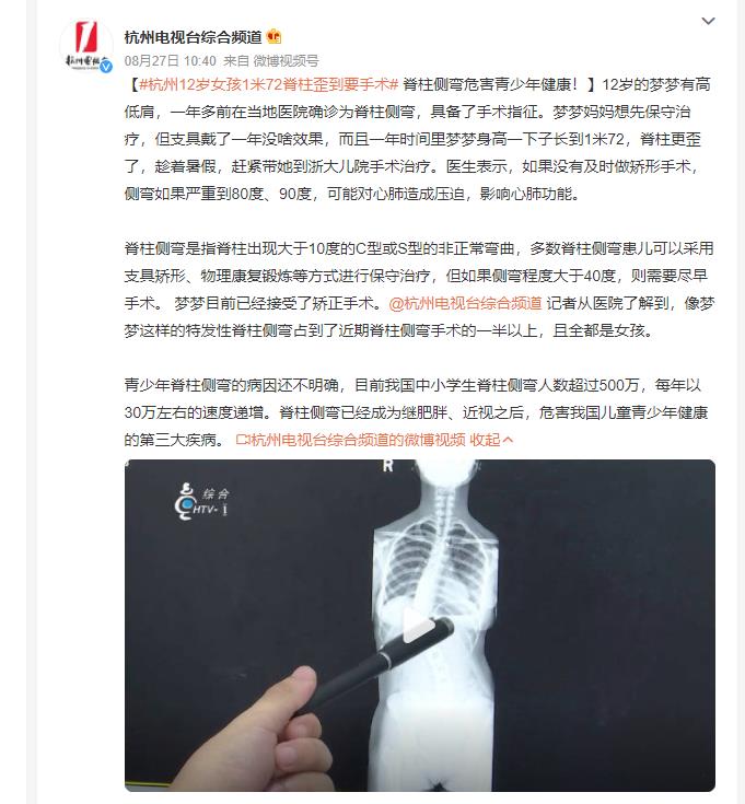 杭州12岁女孩1米72脊柱歪到要手术 网友：肉眼可见的歪