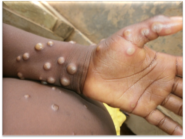 10月新增报告127例猴痘确诊病例 98.2%病例为男性