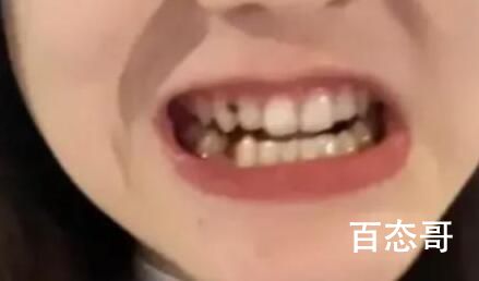 拔掉57颗牙是什么体验 人有这么多牙齿吗？